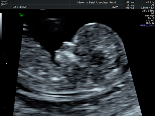 First Trimester Prenatal Screening