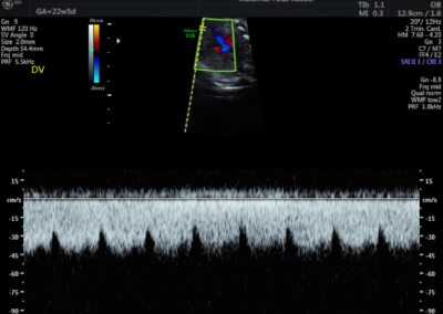 Doppler Evaluation