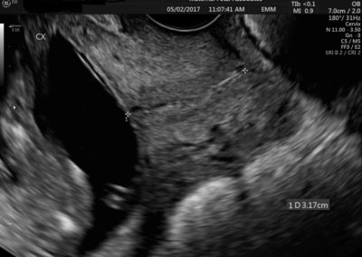 Transvaginal Ultrasound Normal