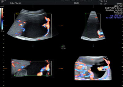 3D Transvaginal Ultrasound