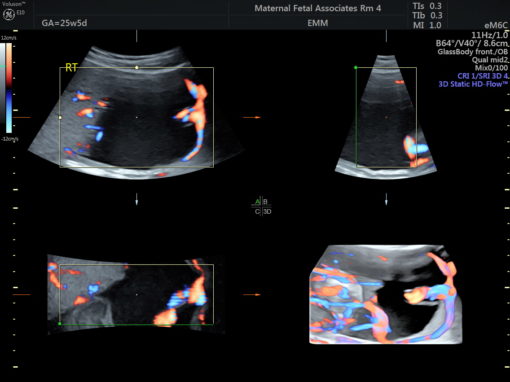 3D Transvaginal Ultrasound