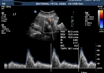 Uterine Artery Doppler Abnormal