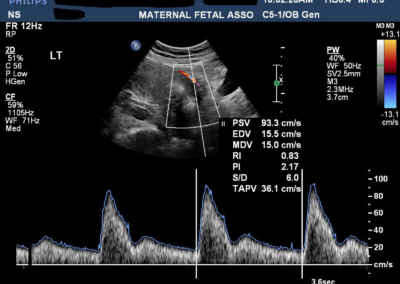 Uterine Artery Doppler Normal