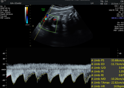 Normal Umbilical arterial Doppler assessment