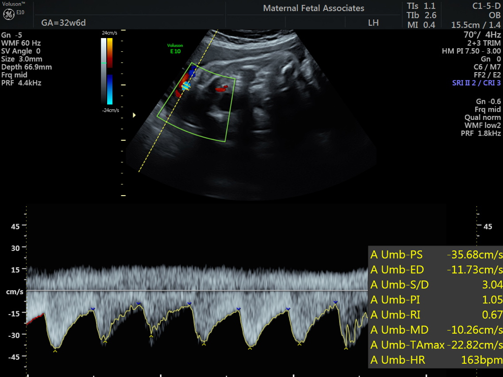 Doppler Evaluation Maternal Fetal Associates Of The Mid Atlantic 