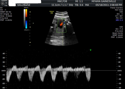 Abnormal Umbilical arterial Doppler assessment