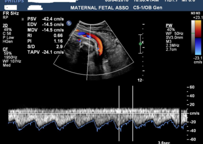 Normal Umbilical arterial Doppler